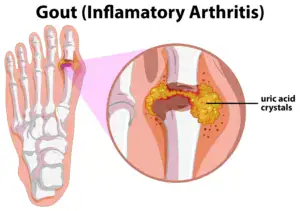 Symptoms of gout