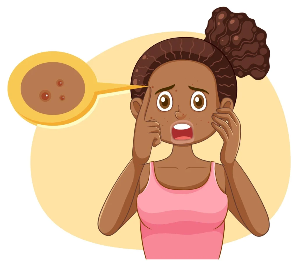 Fights Acne and Breakouts